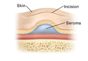 Seroma Seroma