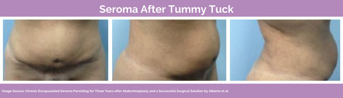 seroma after tummy tuck