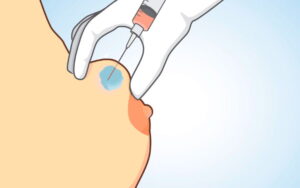 seroma aspiration seroma aspiration