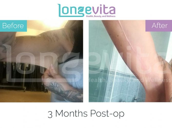 arm lift turkey before after 1 670x500 1