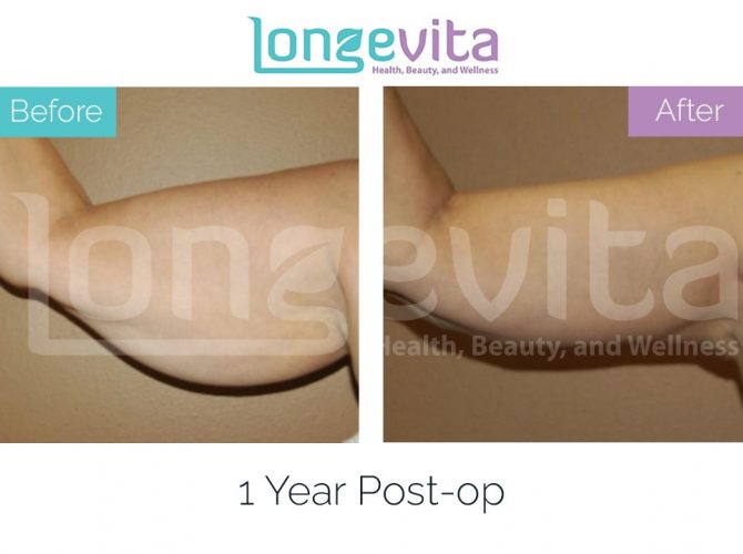 arm lift turkey before after 2 670x500 1