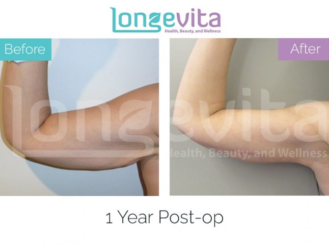 arm lift turkey before after 3 670x500 1