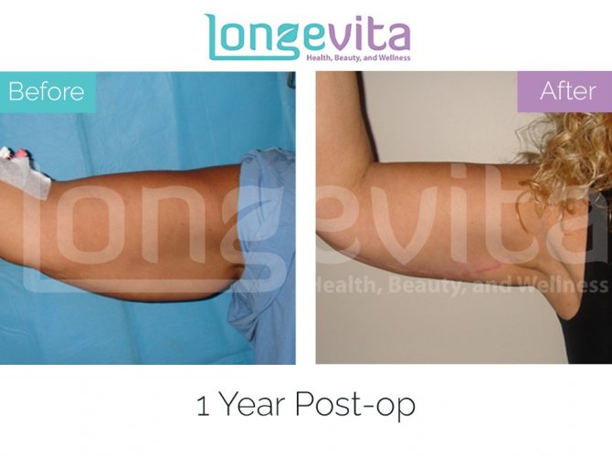 arm lift turkey before after 4 670x500 1