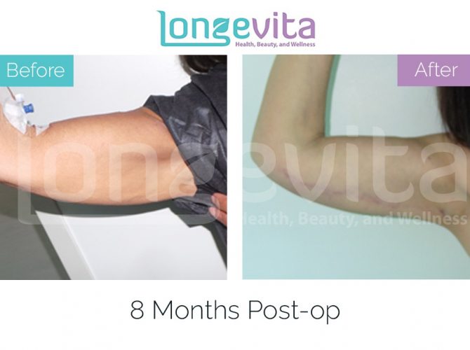 arm lift turkey before after 5 670x500 1