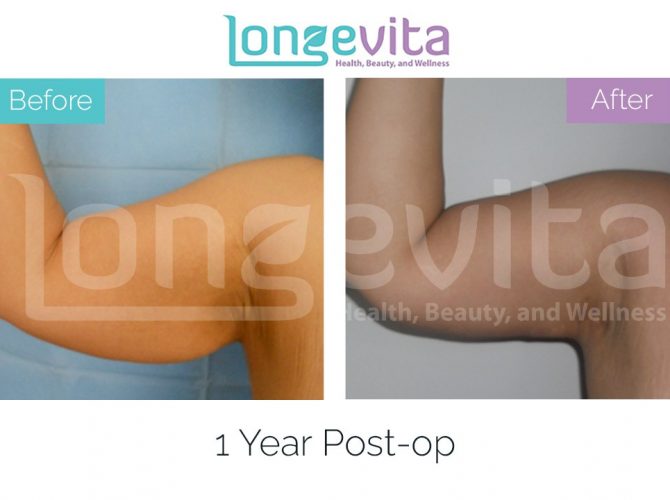 arm lift turkey before after 6 670x500 1