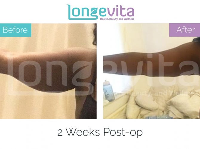 arm lift turkey before after 7 670x500 1