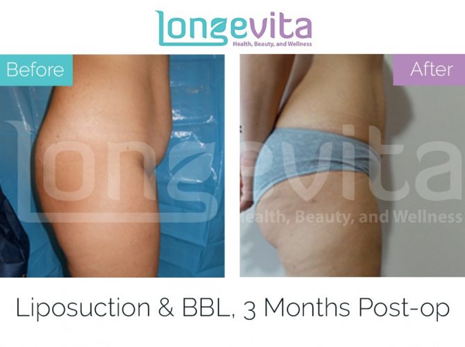 brazilian butt lift turkey before after 1 670x500 1