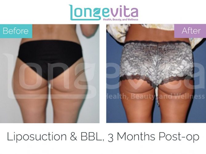brazilian butt lift turkey before after 2 670x500 1