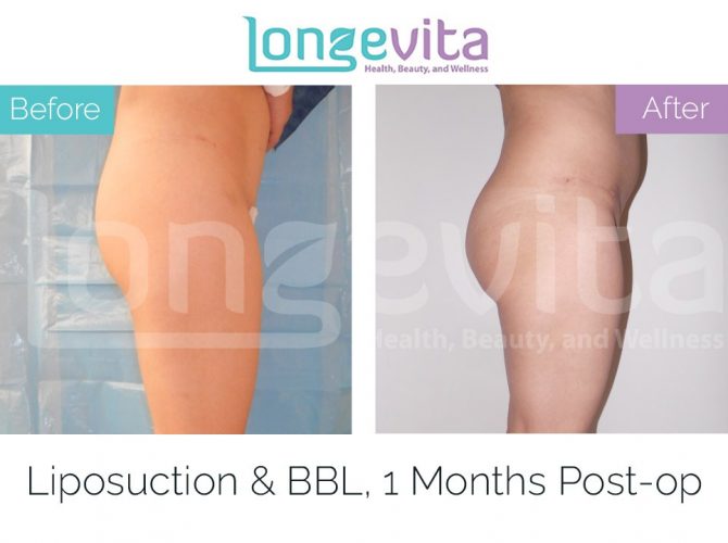 brazilian butt lift turkey before after 3 670x500 1