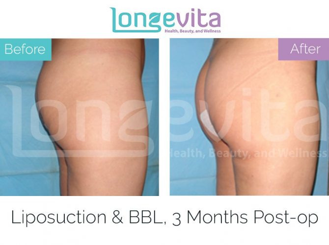 brazilian butt lift turkey before after 4 670x500 1