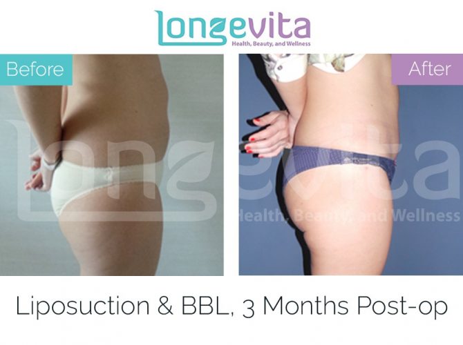 brazilian butt lift turkey before after 6 670x500 1