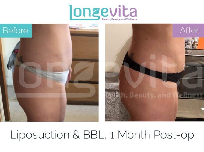 brazilian butt lift turkey before after 7 670x500 1