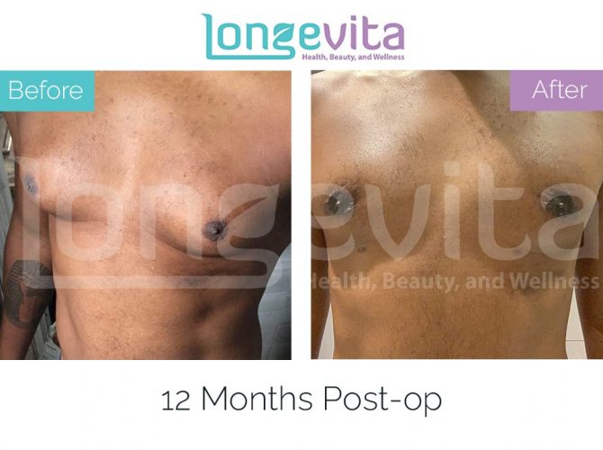 gynecomastia turkey before after 1 670x500 1