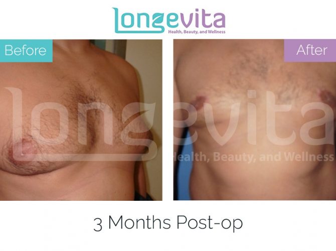 gynecomastia turkey before after 3 670x500 1