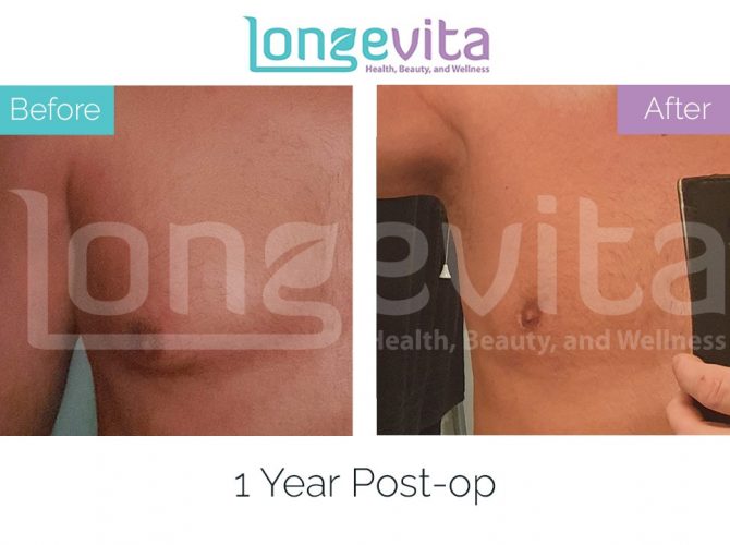 gynecomastia turkey before after 4 670x500 1
