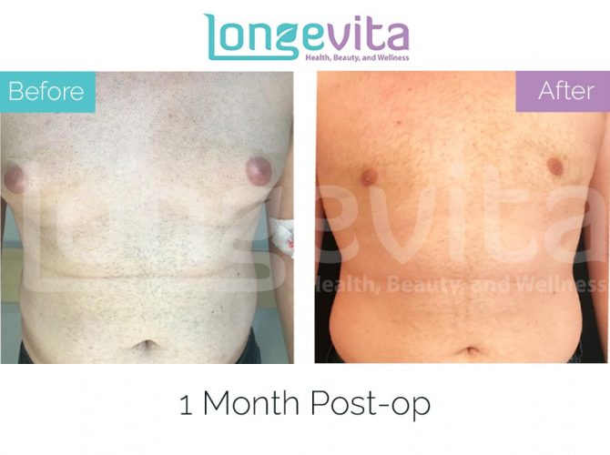 gynecomastia turkey before after 6 670x500 1