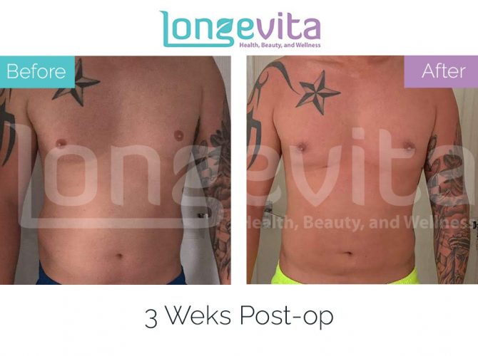 gynecomastia turkey before after 7 670x500 1