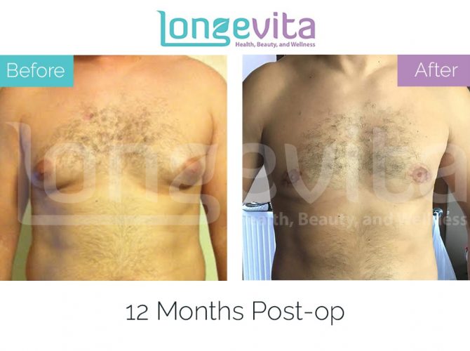 gynecomastia turkey before after 8 670x500 1