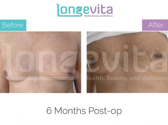 gynecomastia turkey before after 9 670x500 1