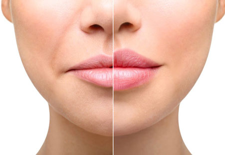 lip fillers migration