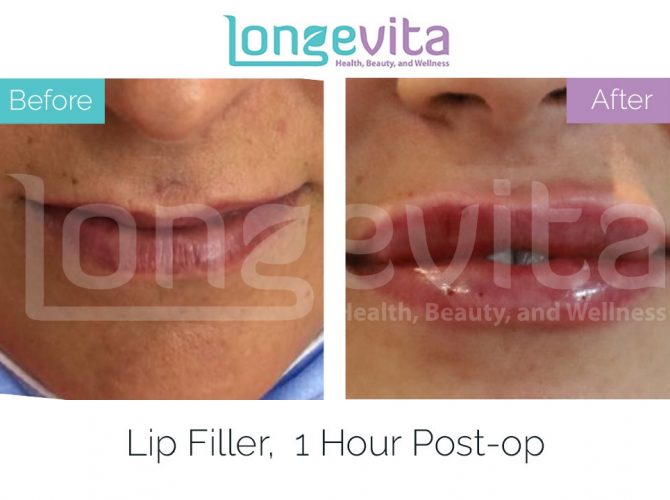 lip fillers turkey before after 3 670x500 1