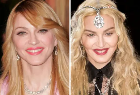 madonna buccal fat