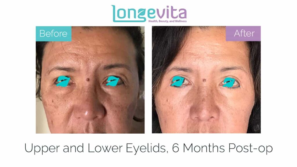 eyelid surgery blepharoplasty