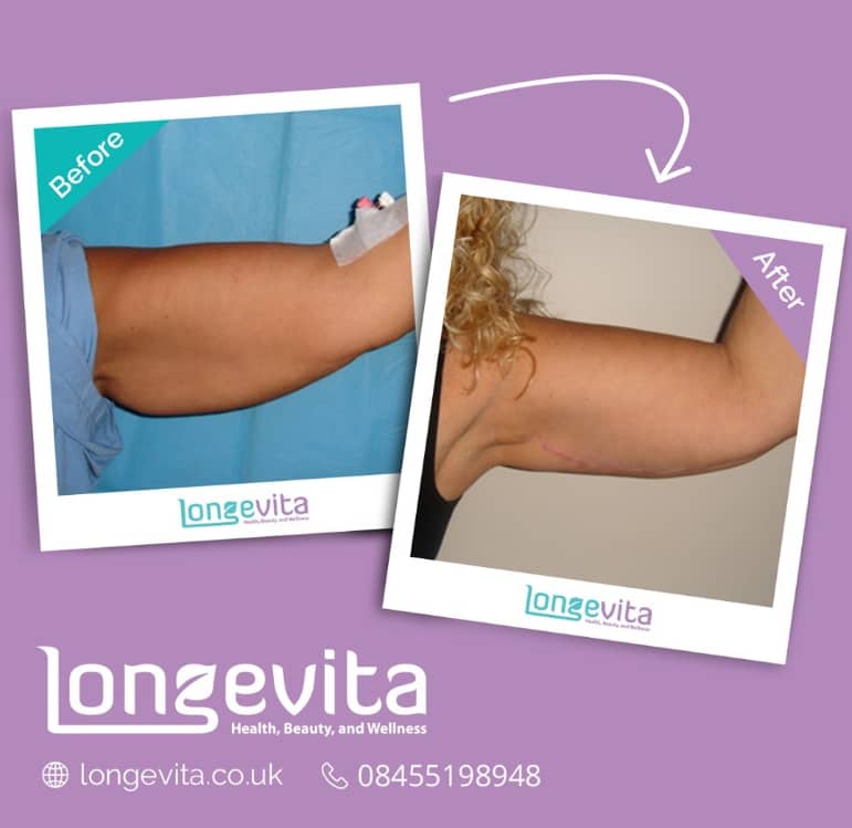 arm lift turkey before after