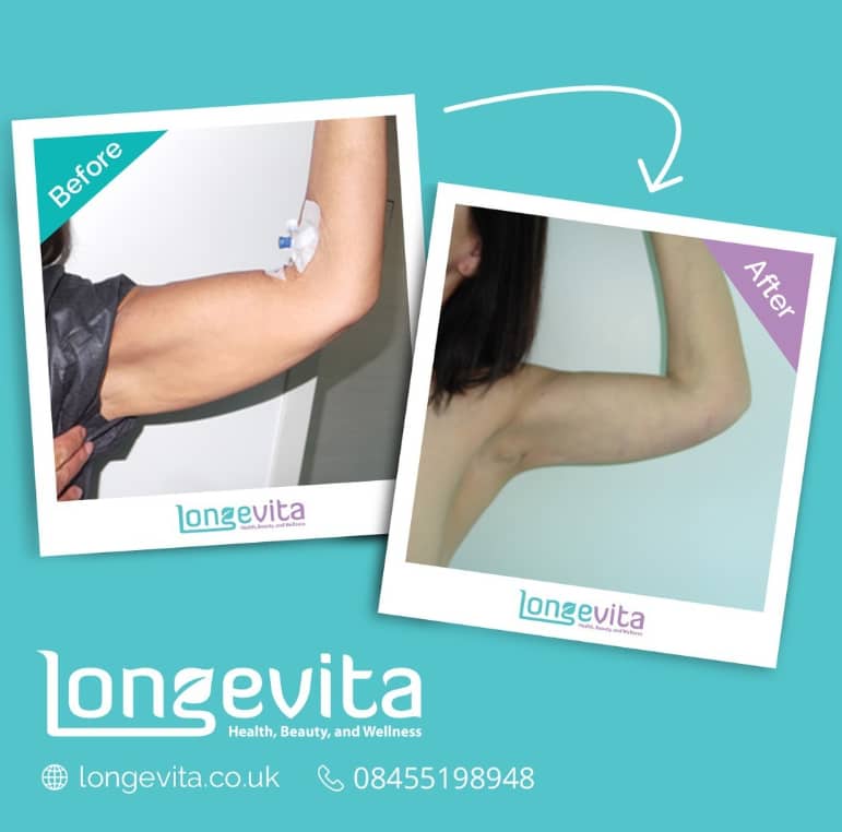 arm lift before and after
