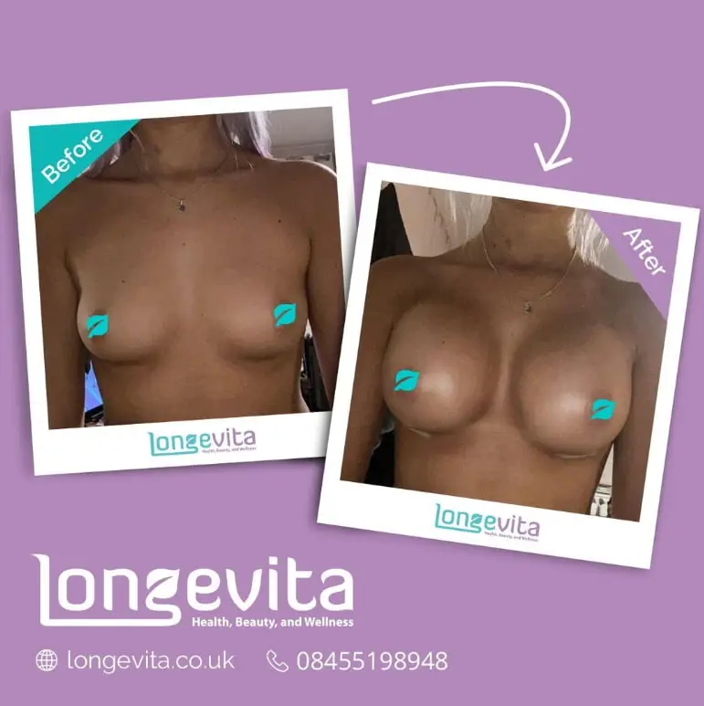 Inframammary Incision Scar before after