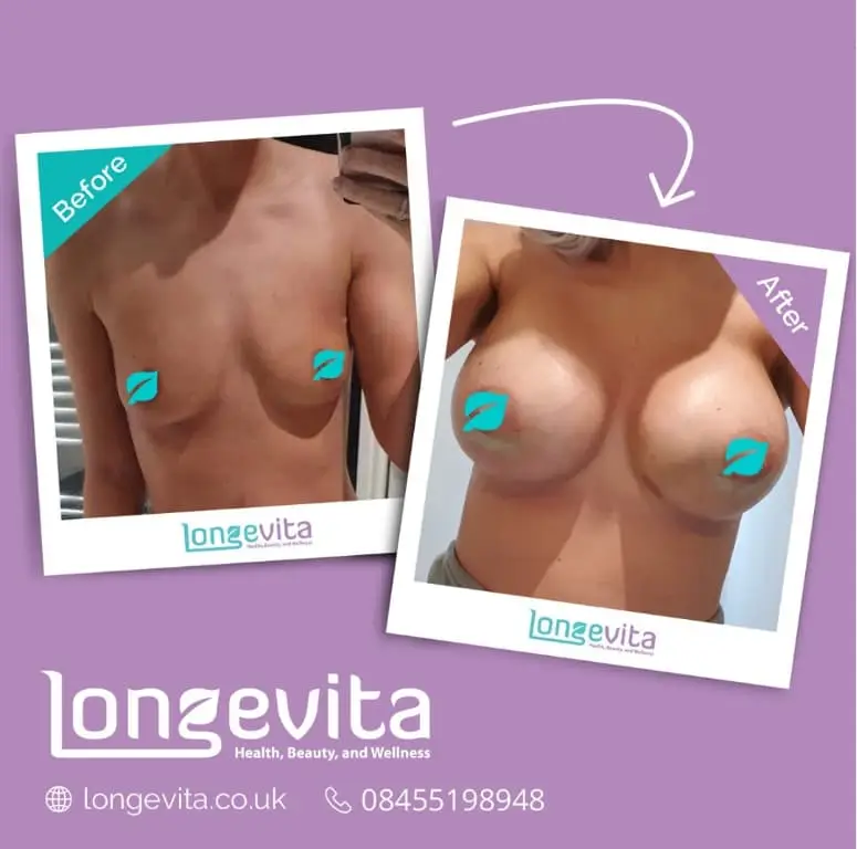 Periareolar Incision Scar before after