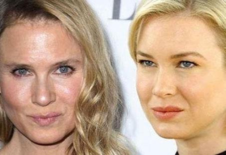 renée-zellweger-plastic-surgery