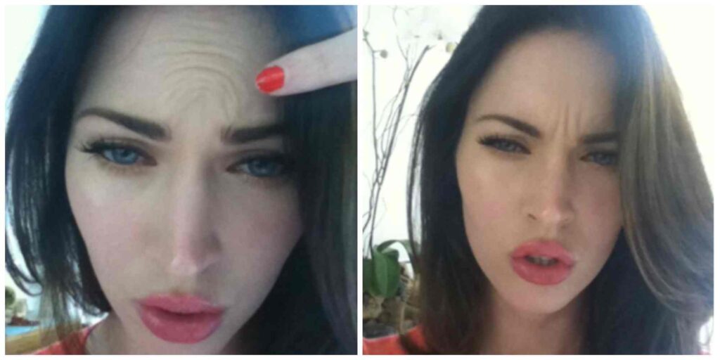 Megan Fox Botox