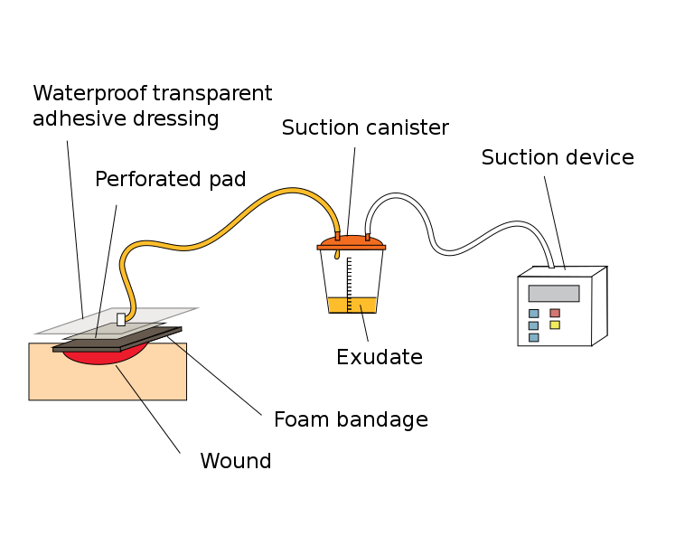 NPWT diagram.svg