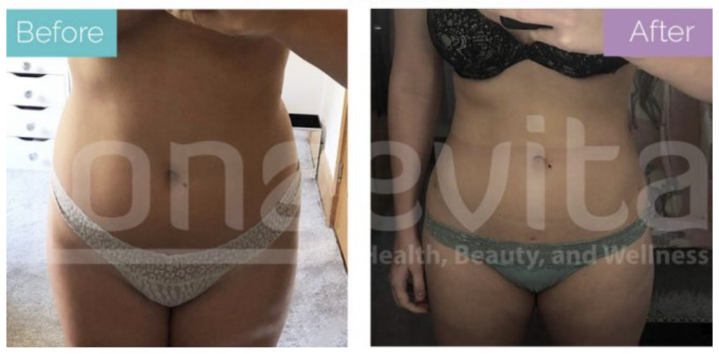 Tight skin after liposuction