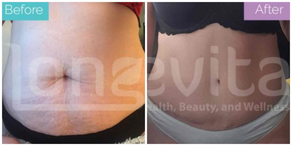tummy tuck before and after