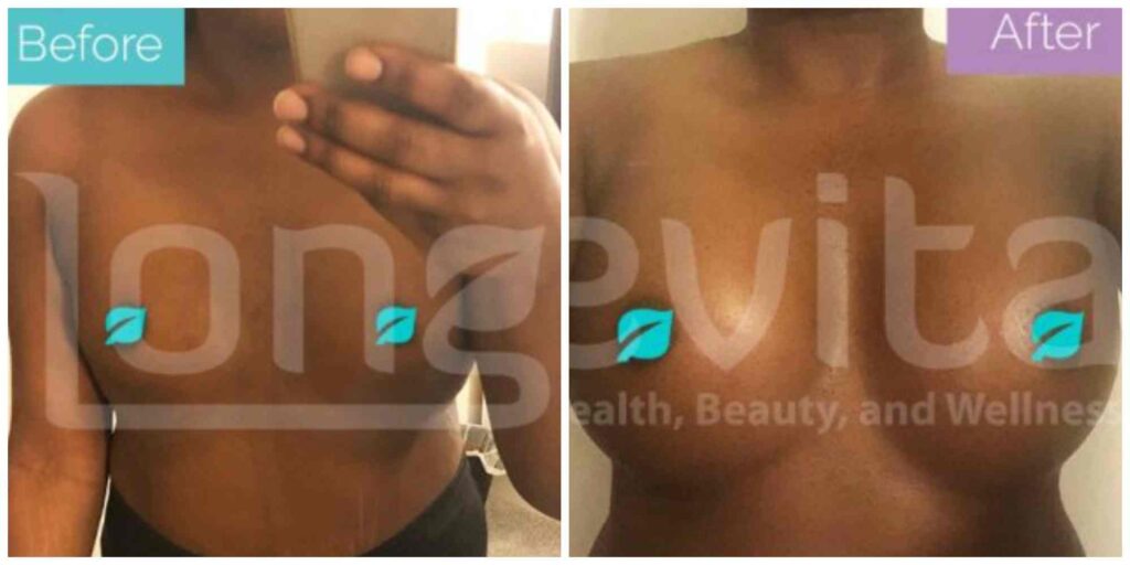 Breast implants before and after