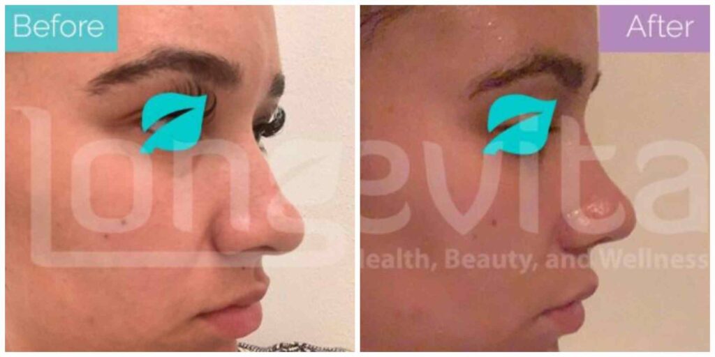 Nose job before and after