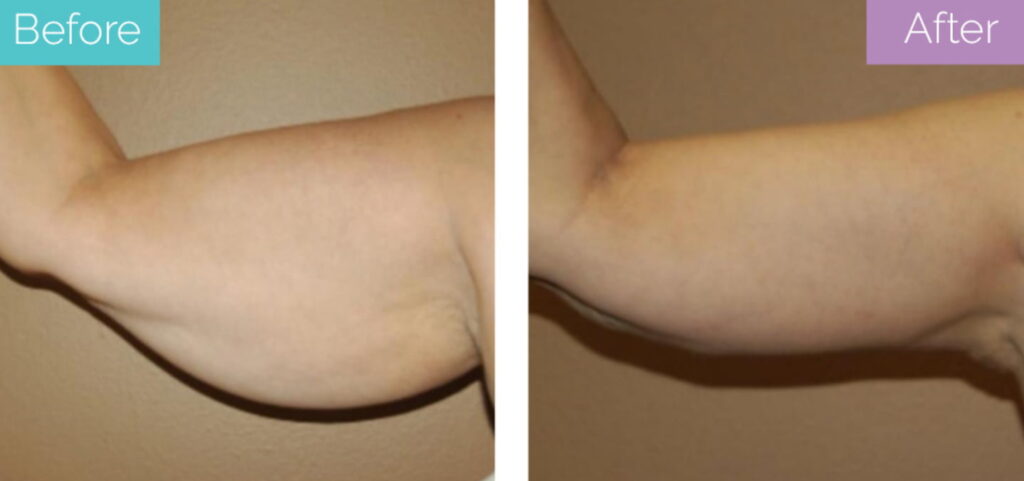 Armlift for bingo wings
