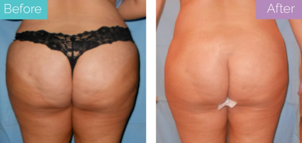 Buttocks vaser lipo