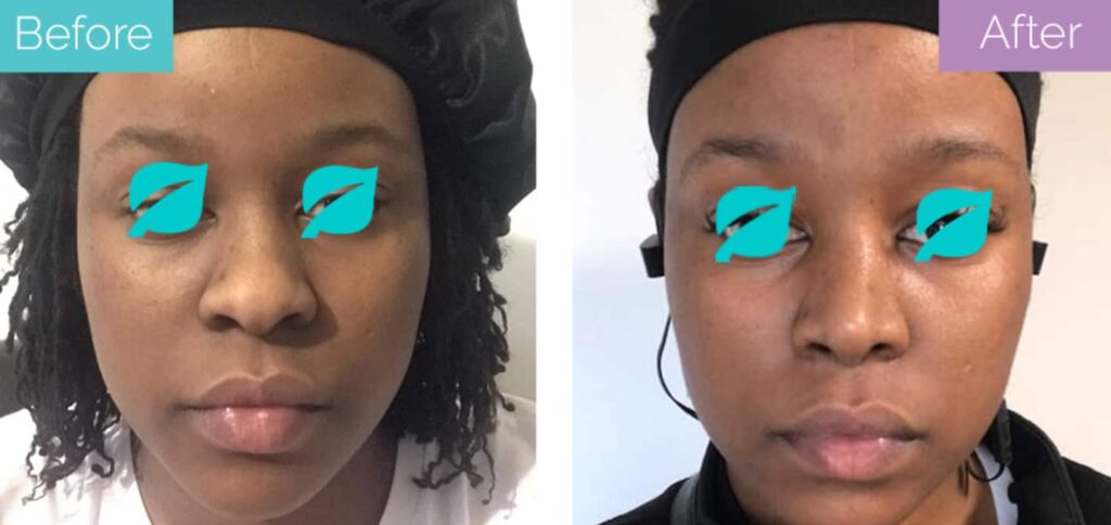 Ethnic nose job