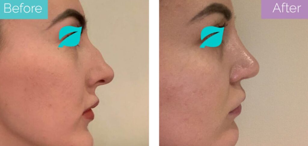 Surgical nose job