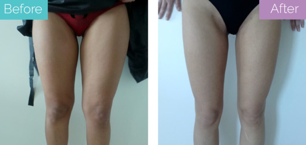 Thigh vaser lipo