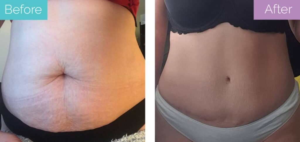 Tummy tuck results