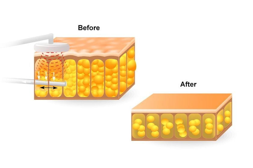 Vaser liposuction