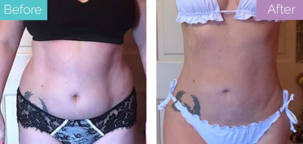 Abdomen 360 lipo