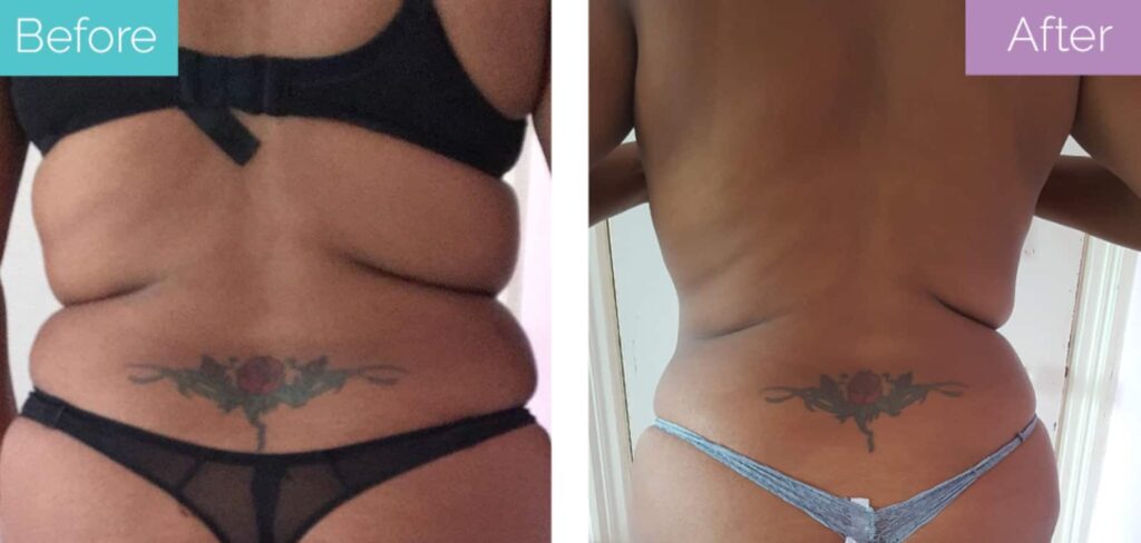 Back 360 lipo