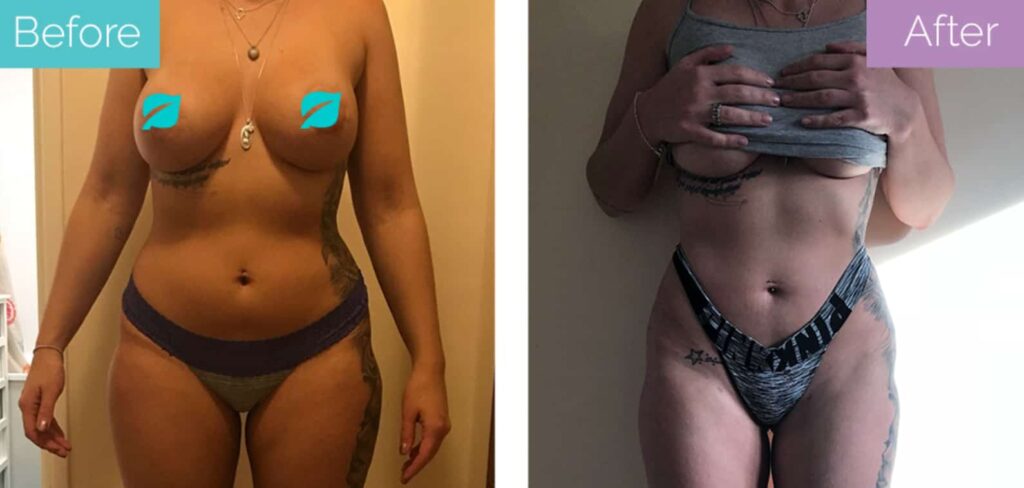 Before and after 360 liposuction