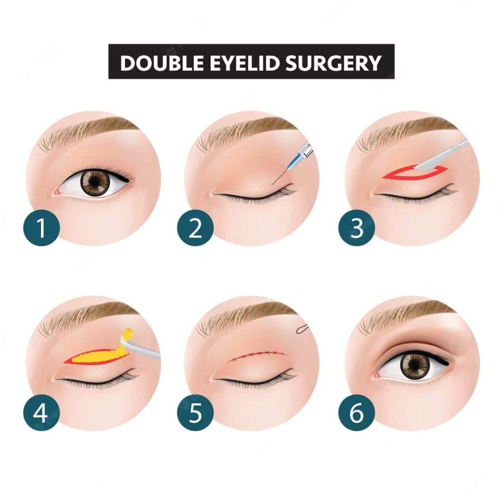 Double eyelid surgery incision method