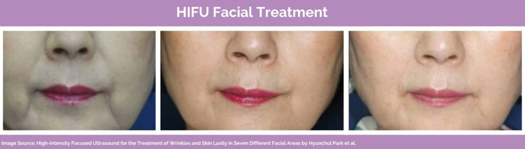 HIFU for face
